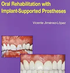 Oral Rehabilitation With Implant Supported
