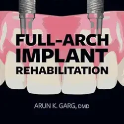 Fullarch Implant Rehabilitation