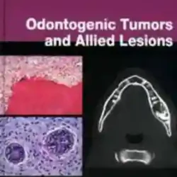 Odontogenic Tumours