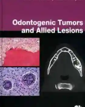 Odontogenic Tumours