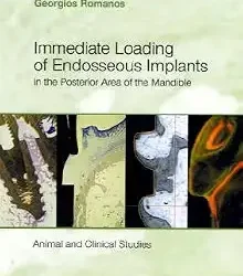 Immediate Loading Of Endosseous Implants