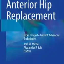 Anterior Hip Replacement