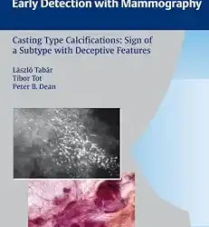 Casting Type Calcifications Sign