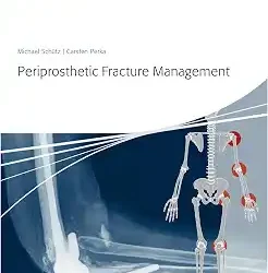 Aotrauma Periprosthetic Fracture Management