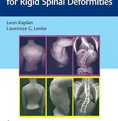 Corrective Osteotomies For Rigid Spinal
