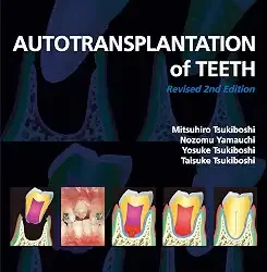Autotransplantation Of Teeth