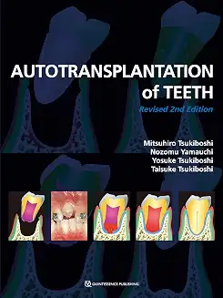 Autotransplantation Of Teeth